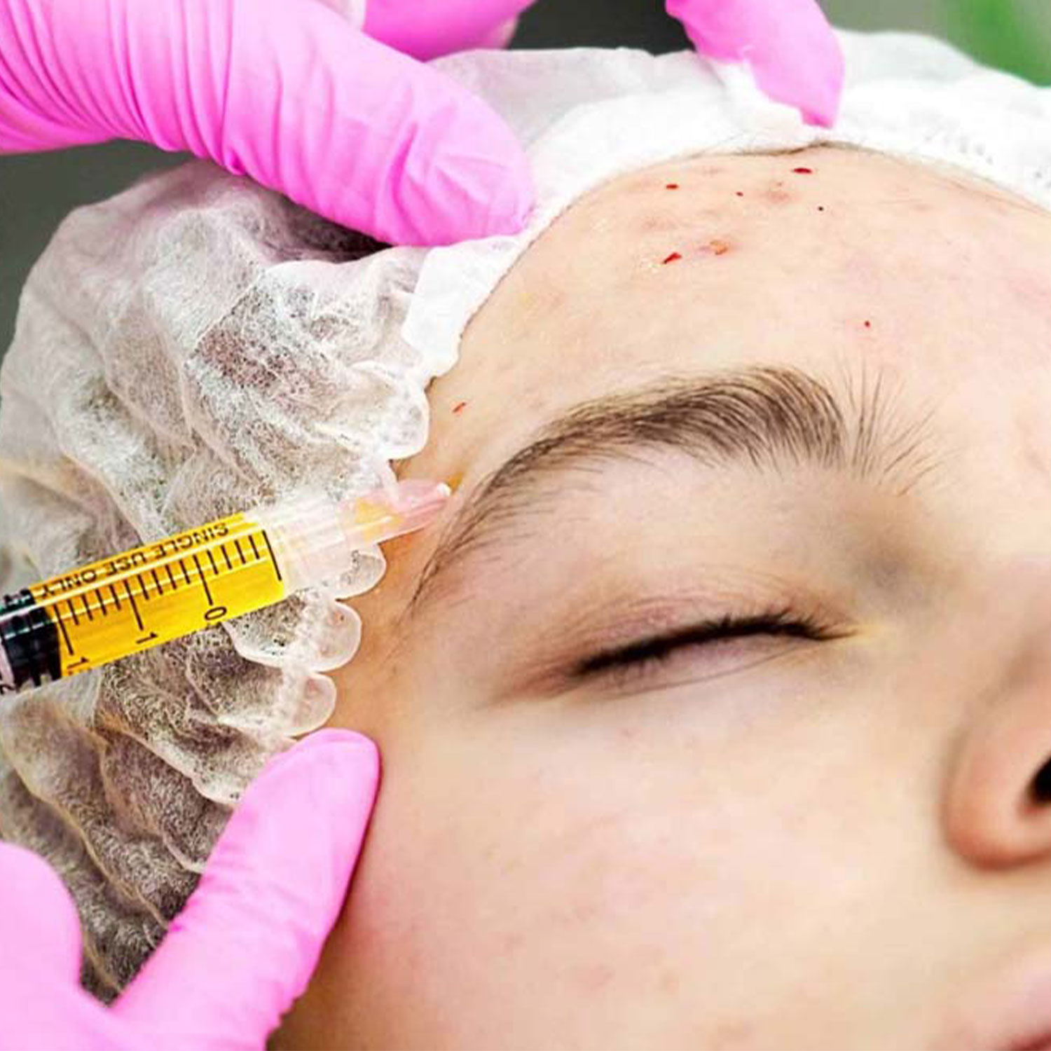 Exosomes-Treatment-karachi---Deduce-Aesthetic-and-Beauty-clinic
