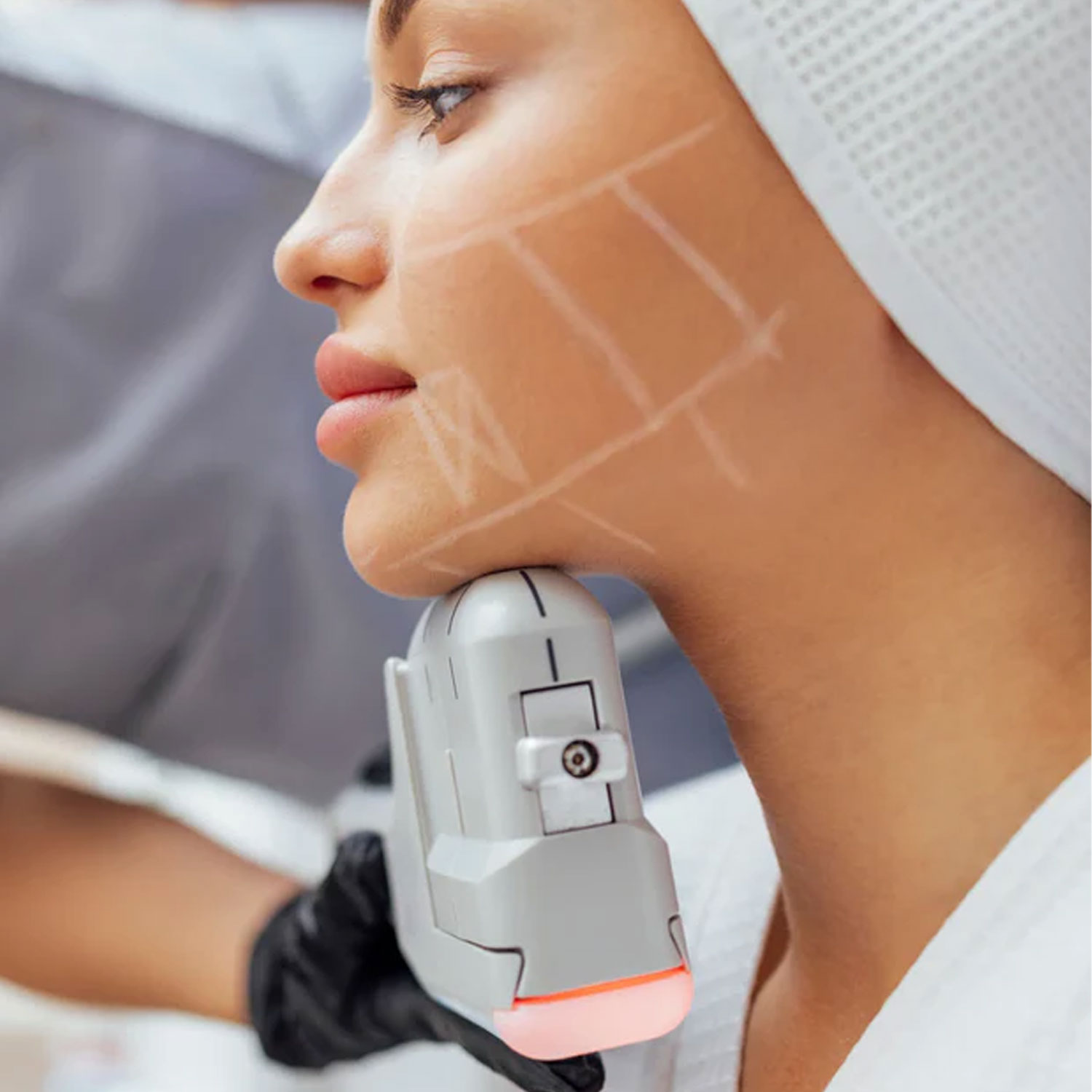 HIFU--Treatment-karachi---Deduce-Aesthetic-and-Beauty-clinic