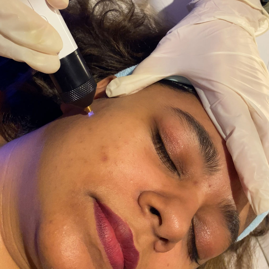 fusion plasma treatment DHA Karachi